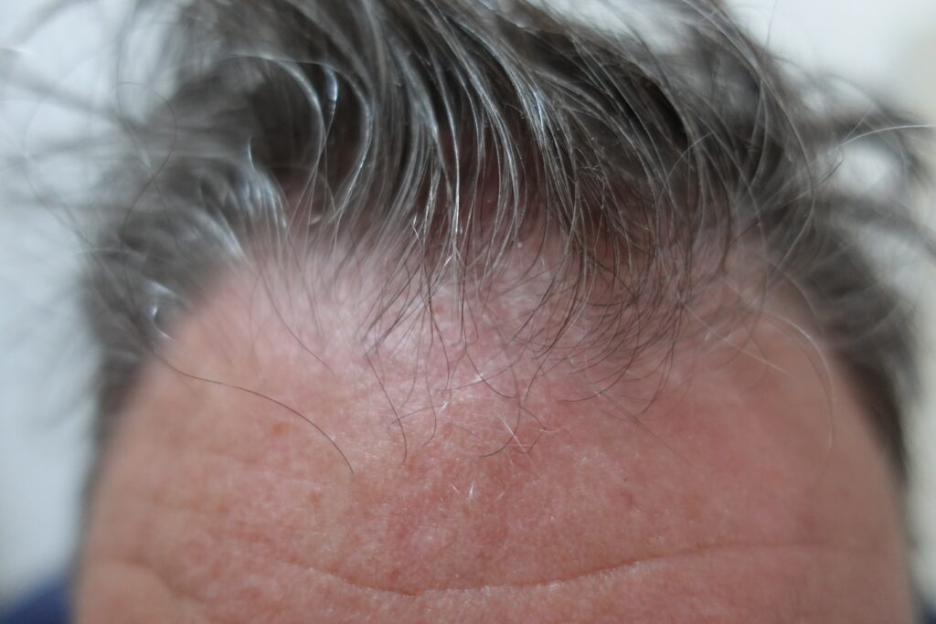 Issue 9 Positive Results Of Scalp Seborrheic Dermatitis Treatment With Cellbooster® Hair Case