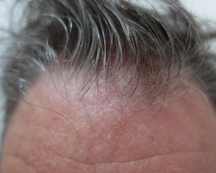 Issue 9 : Positive Results Of Scalp Seborrheic Dermatitis Treatment With CELLBOOSTER® Hair: Case Report