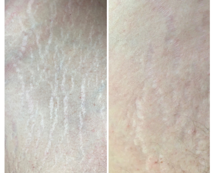 Issue 10: Positive results of striae distensae treatment with CELLBOOSTER® LIFT: Case Report