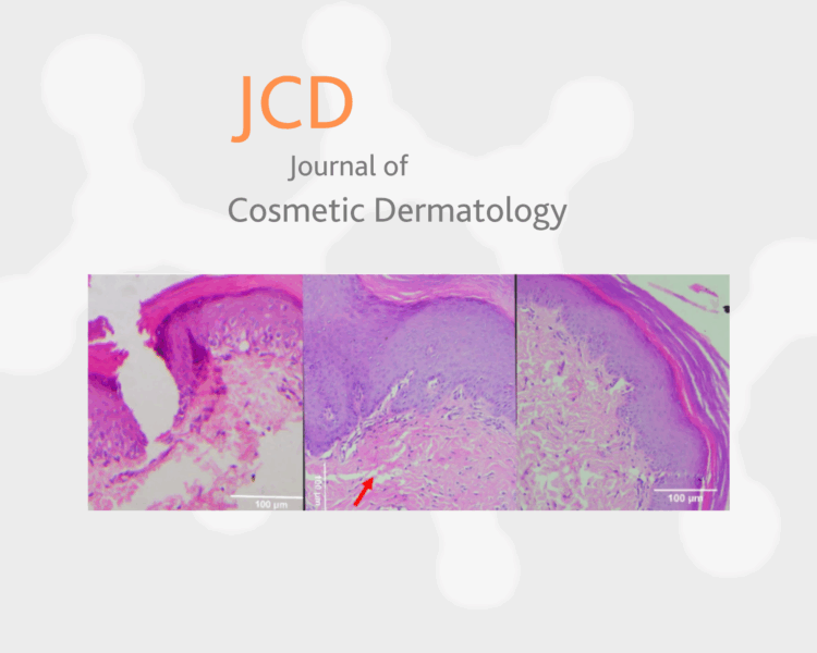 Issue 15: Journal of Cosmetic Dermatology: Skin Wound Healing Following Injecting Hyaluronic Acid Rejuvenating Complex